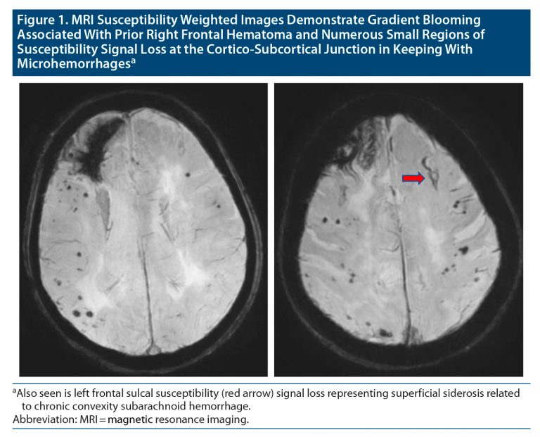 An Elusive Case Of Cerebral Amyloid Angiopathy Diagnostic And