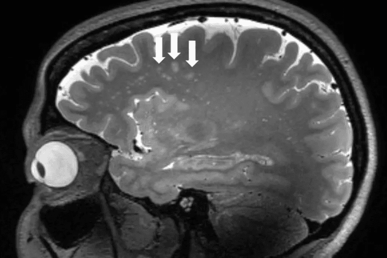 MRI Study Reveals Never Before Seen Brain Changes in Migraine ...