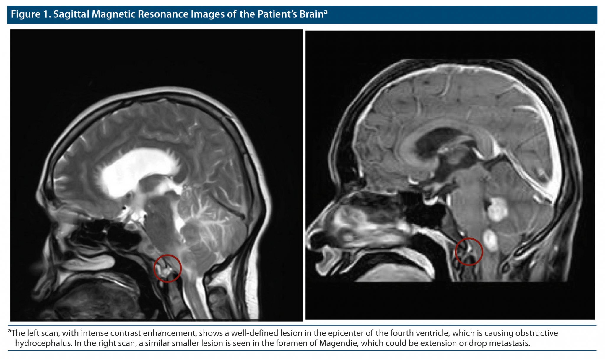 central-nervous-system-lymphoma-presenting-as-psychogenic-vomiting