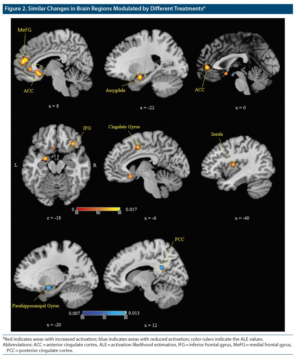 Cureus, Structural MRI Brain Alterations in Borderline Personality Disorder  and Bipolar Disorder