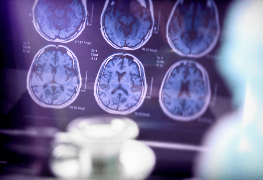 FDA Panel Endorses New Alzheimer’s Drug