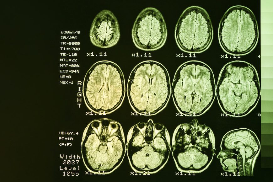 Huntington’s Brain Changes Show Up Decades Before Symptoms